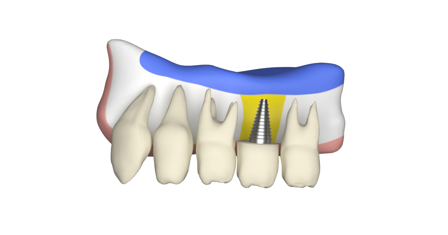 Dental Implants Dental Implant Center of PA