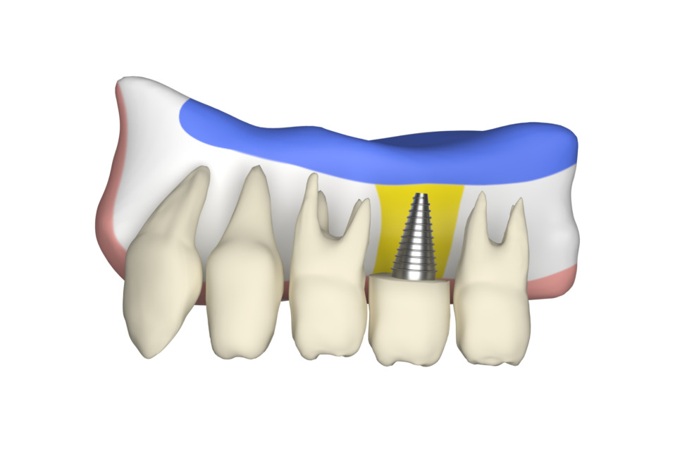 Dental Implants Dental Implants Graphic