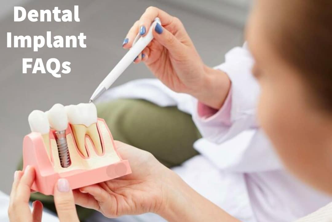 Dental Implant FAQs