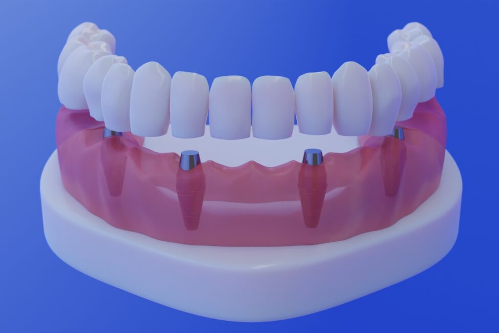 Implants_All-On-Four Implants_All-On-Four