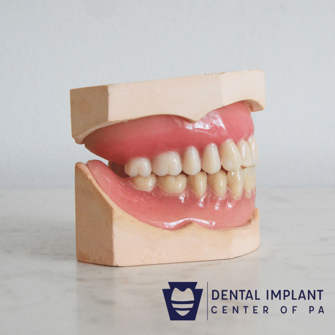 alternatives to dental implants