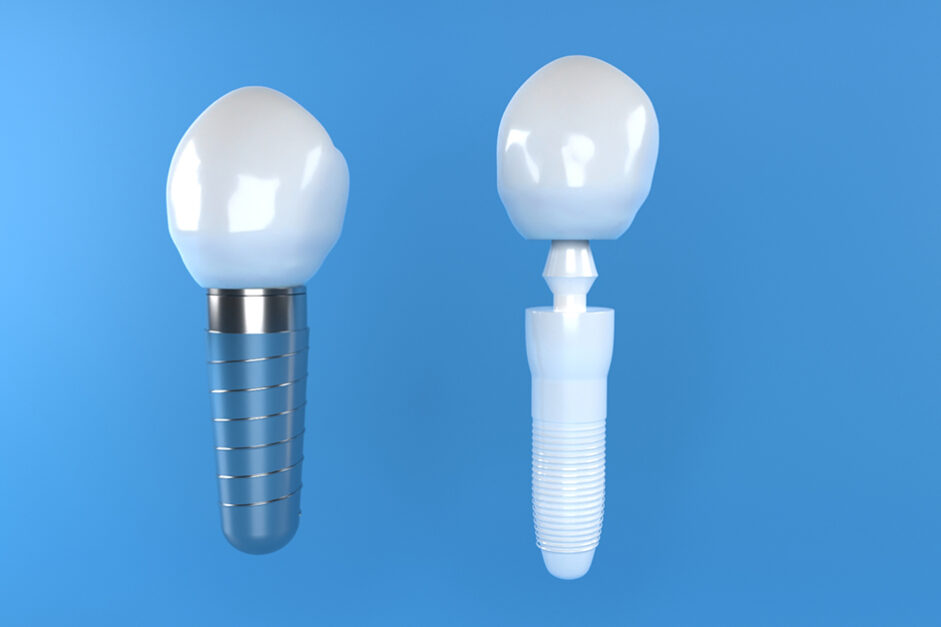DentalImplantsTitaniumZirconia DentalImplantsTitaniumZirconia
