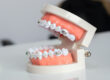 braces for implants