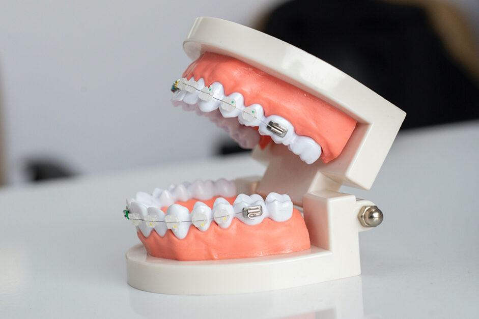 braces braces for implants