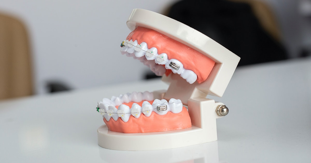 Orthodontics and Dental Implants: Aligning Teeth for Implant