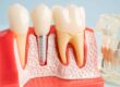 Dental Implants in Central PA