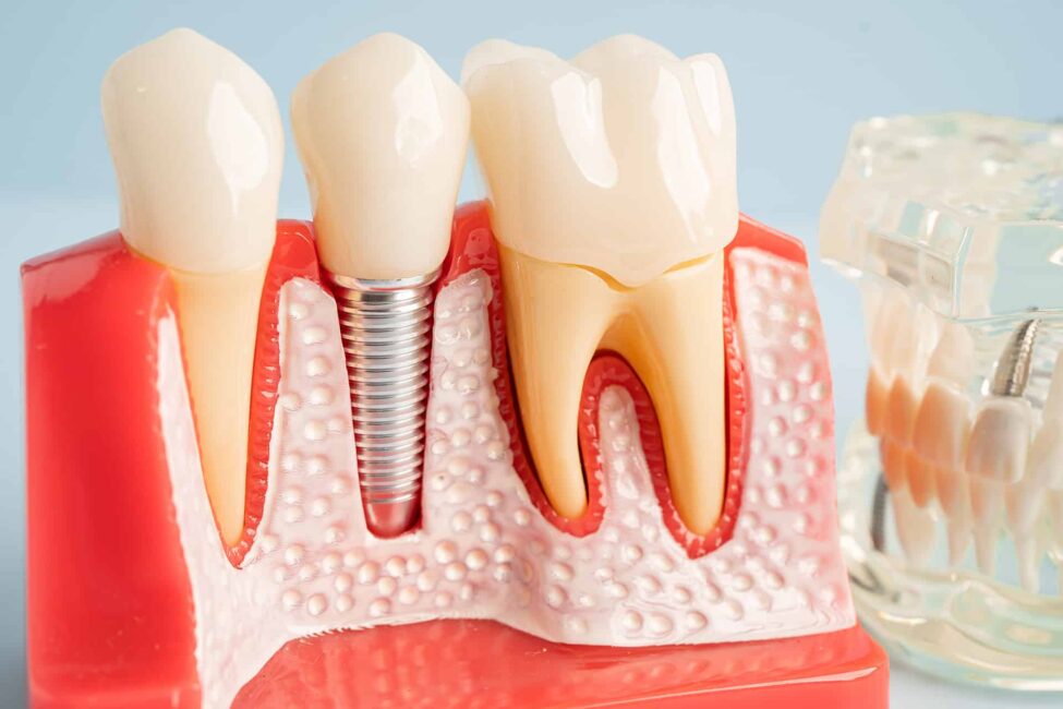 implants Dental Implants in Central PA